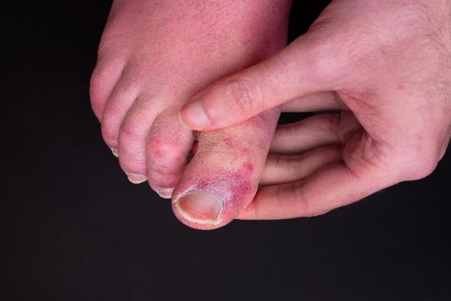 אדם סובל מאודם בבהונות הרגליים שיכול להעיד על מחלת קוביד 19 קלה